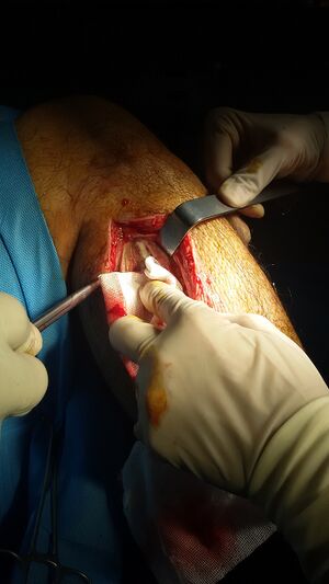 1024px-Compartment syndrome with fasciotomy procedure 01.jpeg