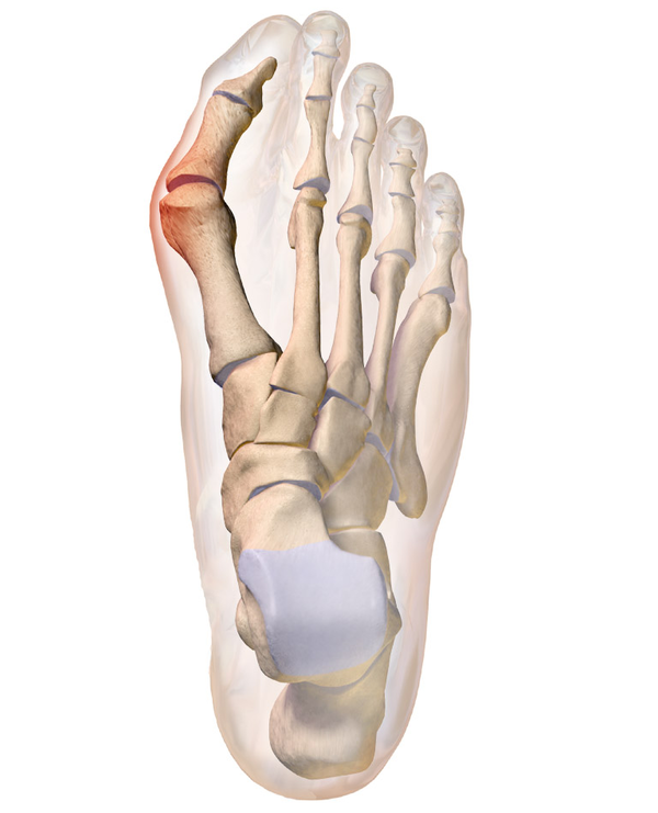 hallux-valgus-physiopedia