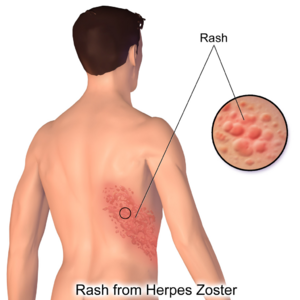 Herpes Zoster Rash.png