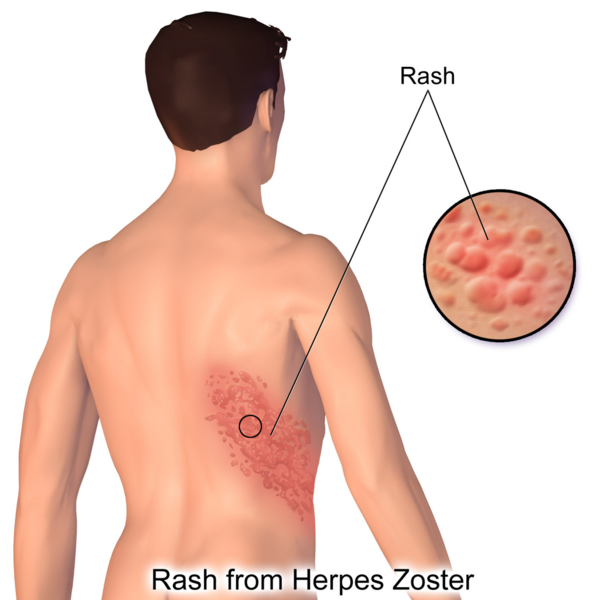 File:Herpes Zoster Rash.png