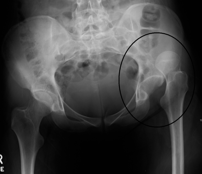 File:Hip dislocation.png