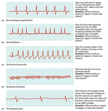 heart rhythm bradycardia