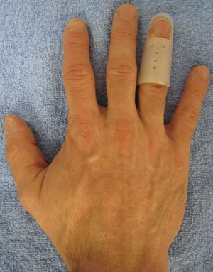 broken middle finger cast