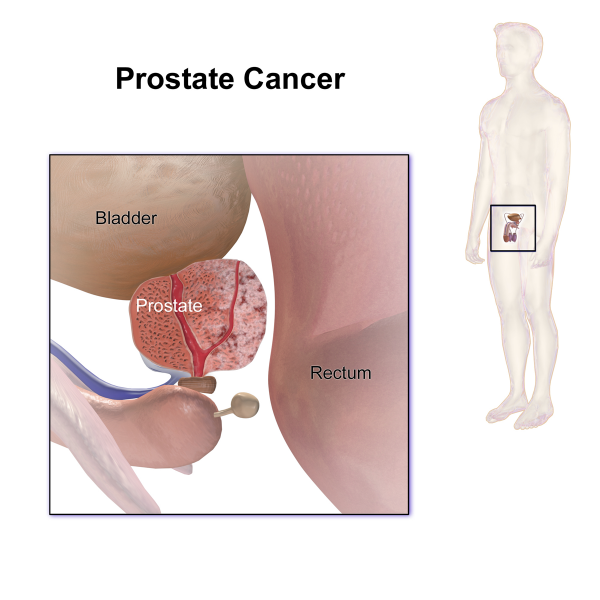 File:Prostate Cancer.png