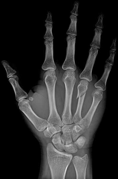 File:4th Metacarpal Bone Fracture.jpg