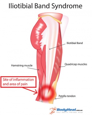 Physical Therapy in Jackson for Knee - Iliotibial Band Syndrome