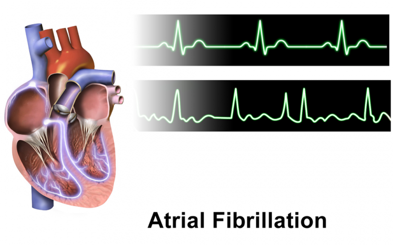File:Atrial Fibrillation TPMJM BUDPT.png