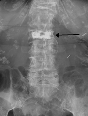 Lumbar Compression Fracture - Physiopedia