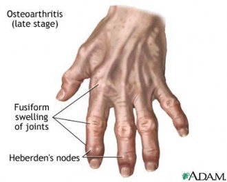 osteoarthritis hands