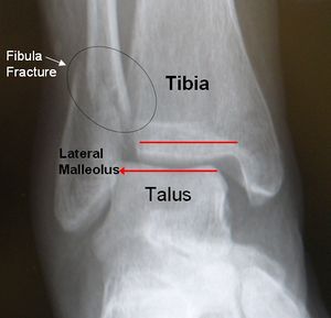 fractured fibula