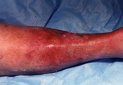 cellulitis leg