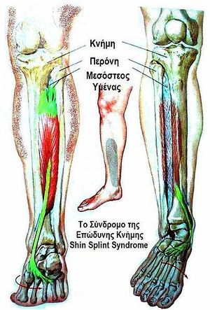 Shin Splints Physiopedia
