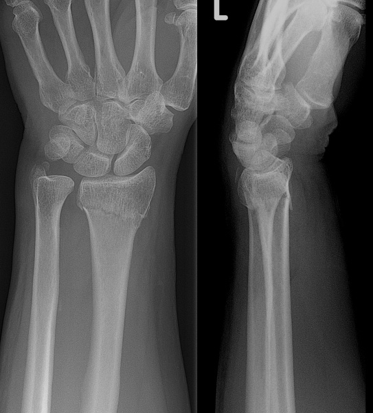 File:Colles fracture radiograph.jpg