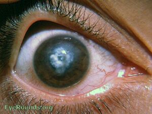 Photograph of an eye, with visible scar tissue covering the pupil.