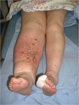 Chronic Venous Insufficiency and Lymphedema - Lymphedema Therapy Specialists
