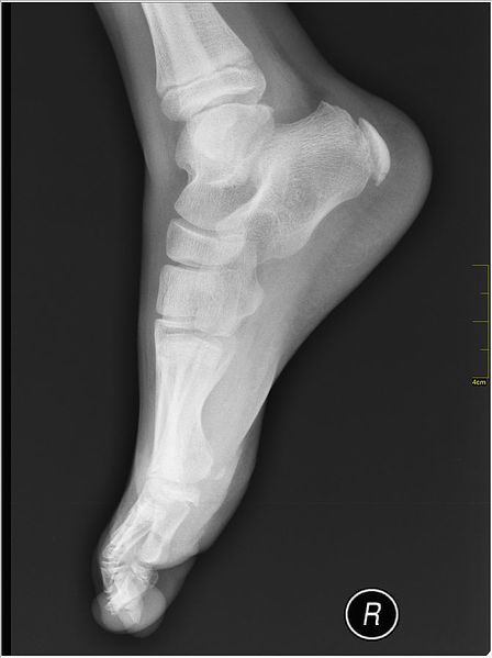 File:Medical X-Ray imaging Sever's Disease.jpg