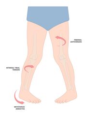 Paediatric Lower Extremity Torsional Conditions - Physiopedia