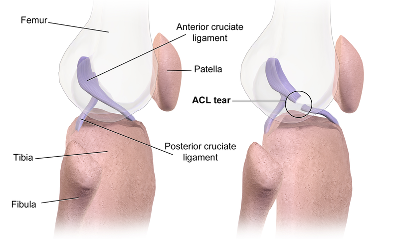 File:ACL Tear.png