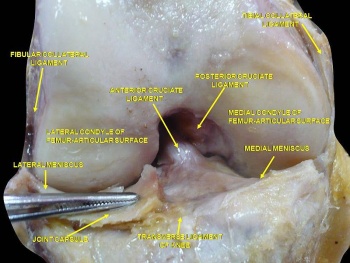 Arthroscopic picture of left knee revealing (a) bulky anterior cruciate