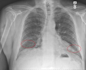 Pulmonary fibrosis.jpg