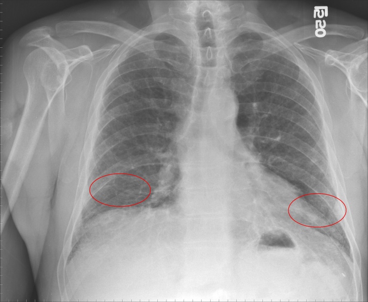 File:Pulmonary fibrosis.jpg