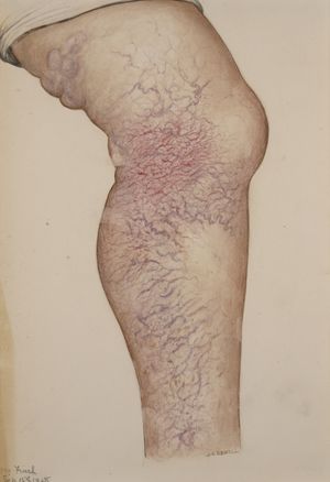 Extensive varicose veins.jpg