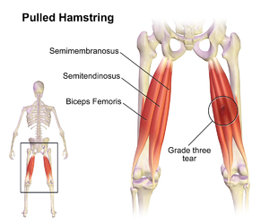Hamstring Strain - Physiopedia