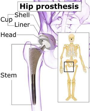 bipolar hemiarthroplasty vs total hip replacement