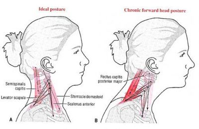 forward head posture neck hump
