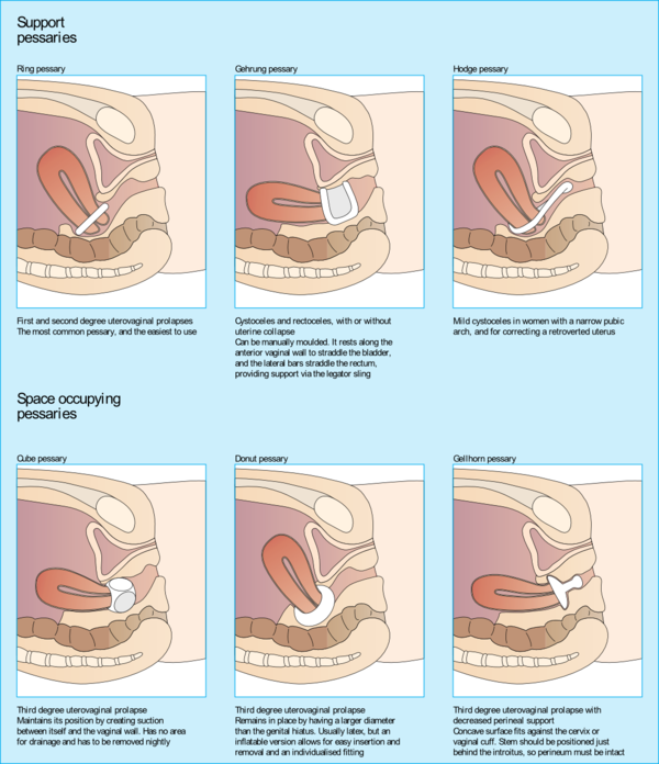 After birth—bladder assessment - Patient Information Brochures - Mater Group