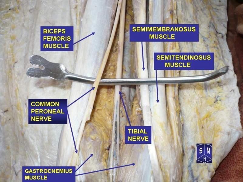 File:Common peroneal nerve.jpg