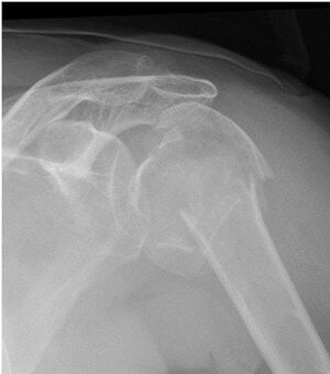 X-ray of fracture of proximal humerus.jpeg