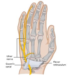 Ulnar nerve entrapment - Wikipedia