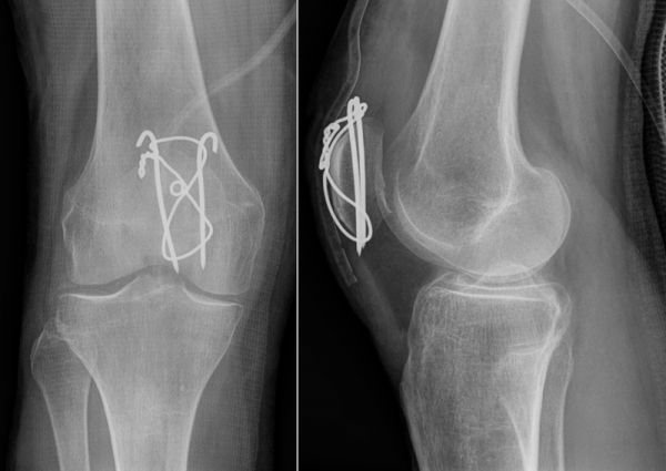 Patellar Fractures Physiopedia