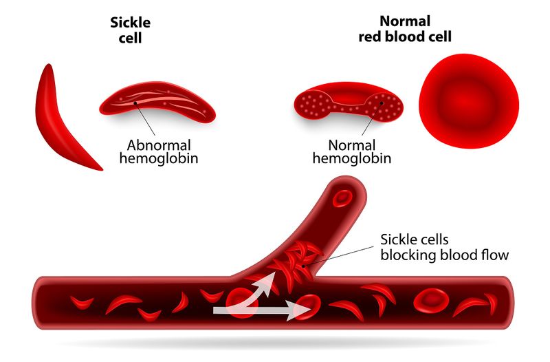 File:Sickle Cell block.jpg