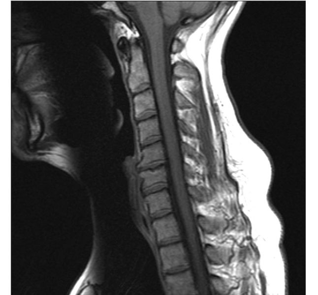 File:MRI of the Cervical Spine showing degenerative changes.jpg