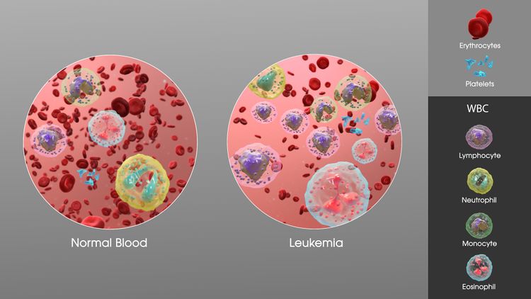 Leukemia - Physiopedia