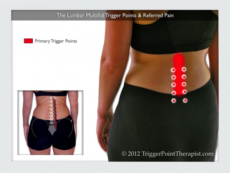 File:Lumbar multifidus trigger points referred pain.jpg