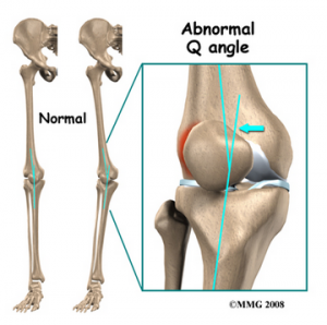 Patella Tracking Disorder - Patella Conditions - Knee - Conditions -  Musculoskeletal - What We Treat 