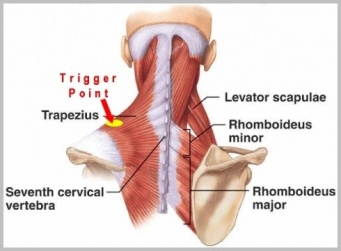 Trigger Point Injection, Myofascial Pain Treatment