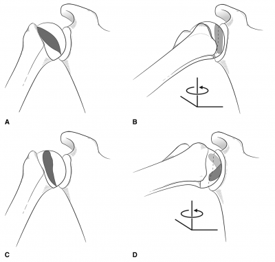 Redrawn with permission from Burkhart SS, De Beer JF: Traumatic glenohumeral bone defects and their relationship to failure of arthroscopic Bankart repairs: Significance of the inverted-pear glenoid and the humeral engaging Hill-Sachs lesion. Arthroscopy 2000;16[7]:677-694.