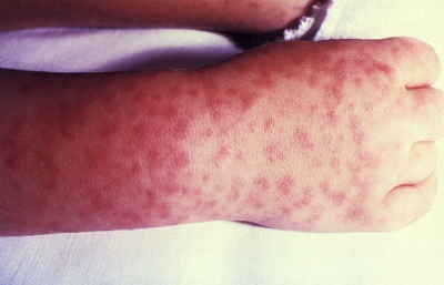 Typical rash seen with Rocky Mountain spotted fever