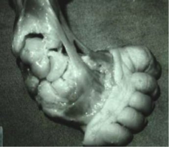 clubfoot deformity measurements x ray