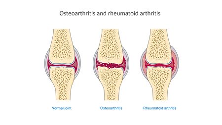 Osteoarthritis and rheumatoid arthritis - Normal joint Osteoarthr -- Smart-Servier.jpg