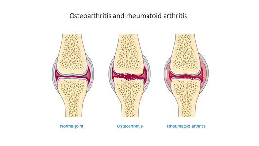 https://www.physio-pedia.com/images/thumb/c/ce/Osteoarthritis_and_rheumatoid_arthritis_-_Normal_joint_Osteoarthr_--_Smart-Servier.jpg/532px-Osteoarthritis_and_rheumatoid_arthritis_-_Normal_joint_Osteoarthr_--_Smart-Servier.jpg