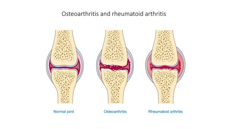 File:Osteoarthritis and rheumatoid arthritis - Normal joint Osteoarthr -- Smart-Servier.jpg
