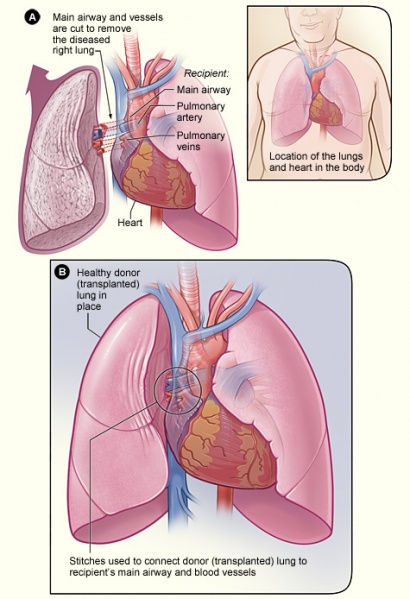 File:Lung transplant...jpg