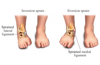 Types of Ankle Sprains, Symptoms and Treatments: Phoenician Foot