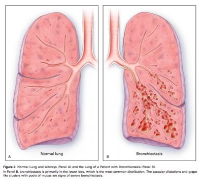 types of bronchiectasis