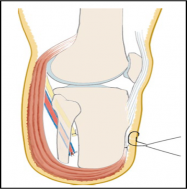 ELong posterior muscular flap covering the distal end, attached ventrally to a shorter anterior flap (ventral suture)